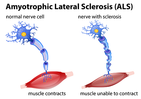 Amyotrophic lateral sclerosis concept