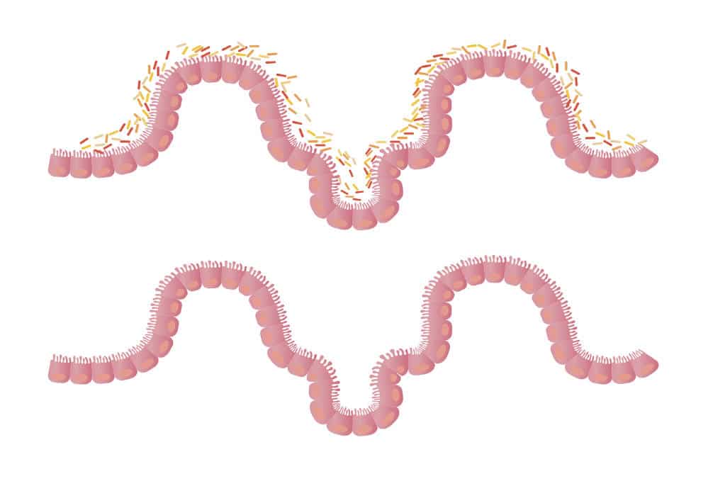 Fecal Microbiota Transplant FMT