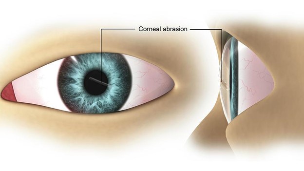Corneal Damage